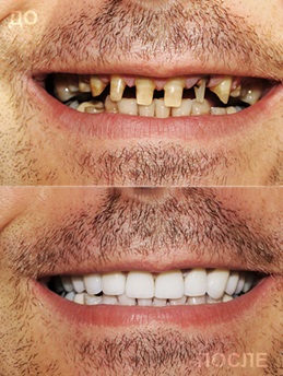 Имплантация зубов Имплантация зубов