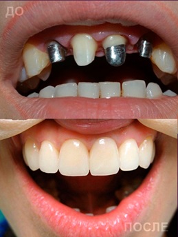 Имплантация зубов Имплантация зубов