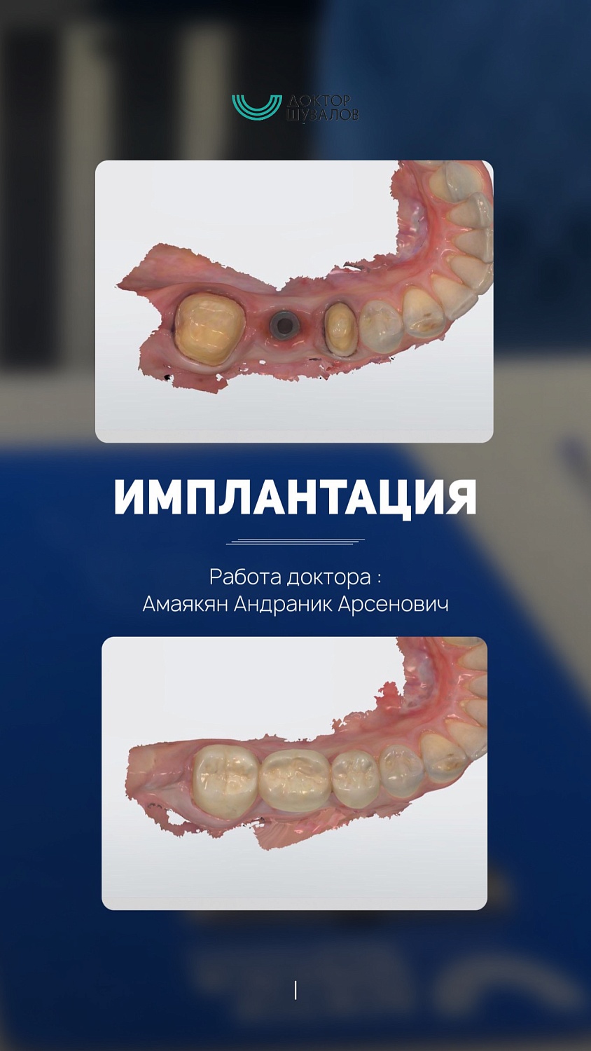 Имплантация зубов