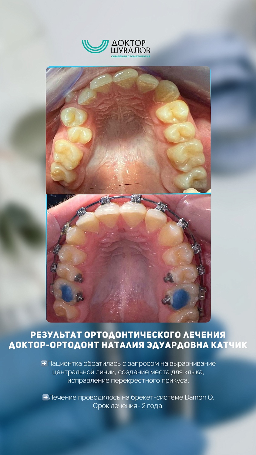 Брекет-системы