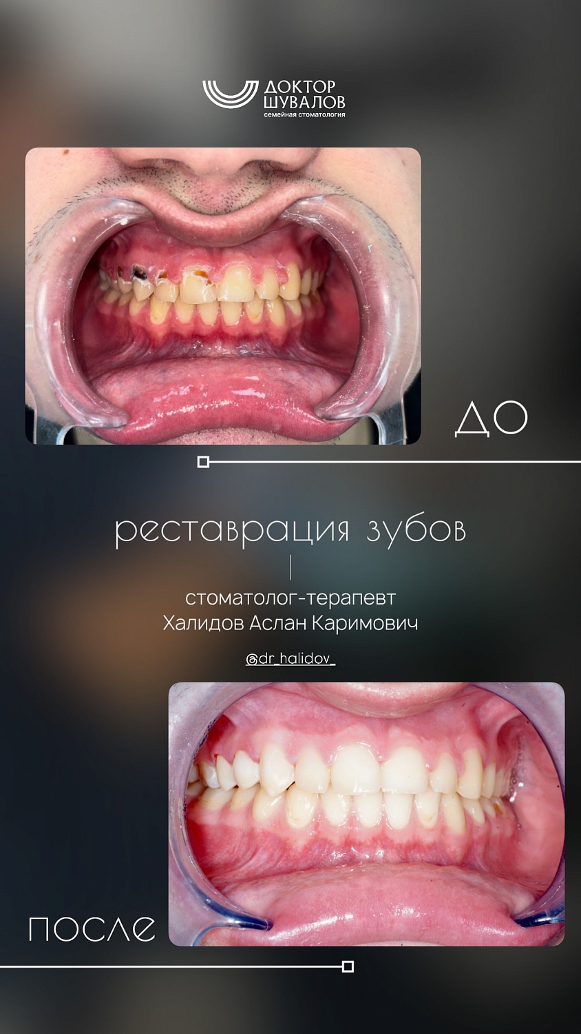 Реставрация зубов