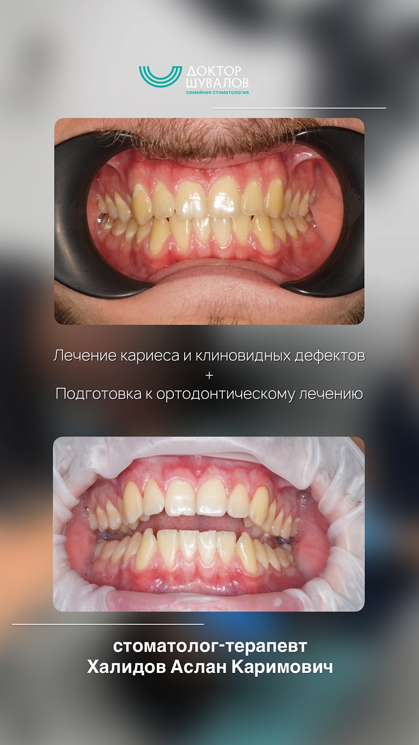 Лечение кариеса