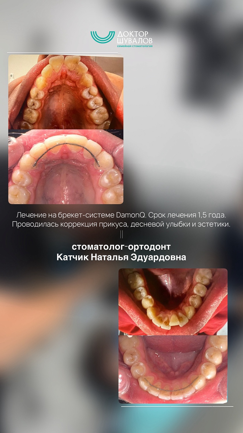 Брекет-системы