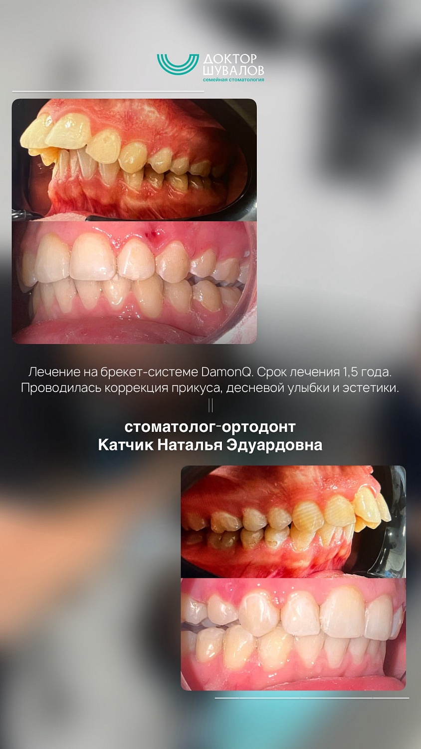 Брекет-системы