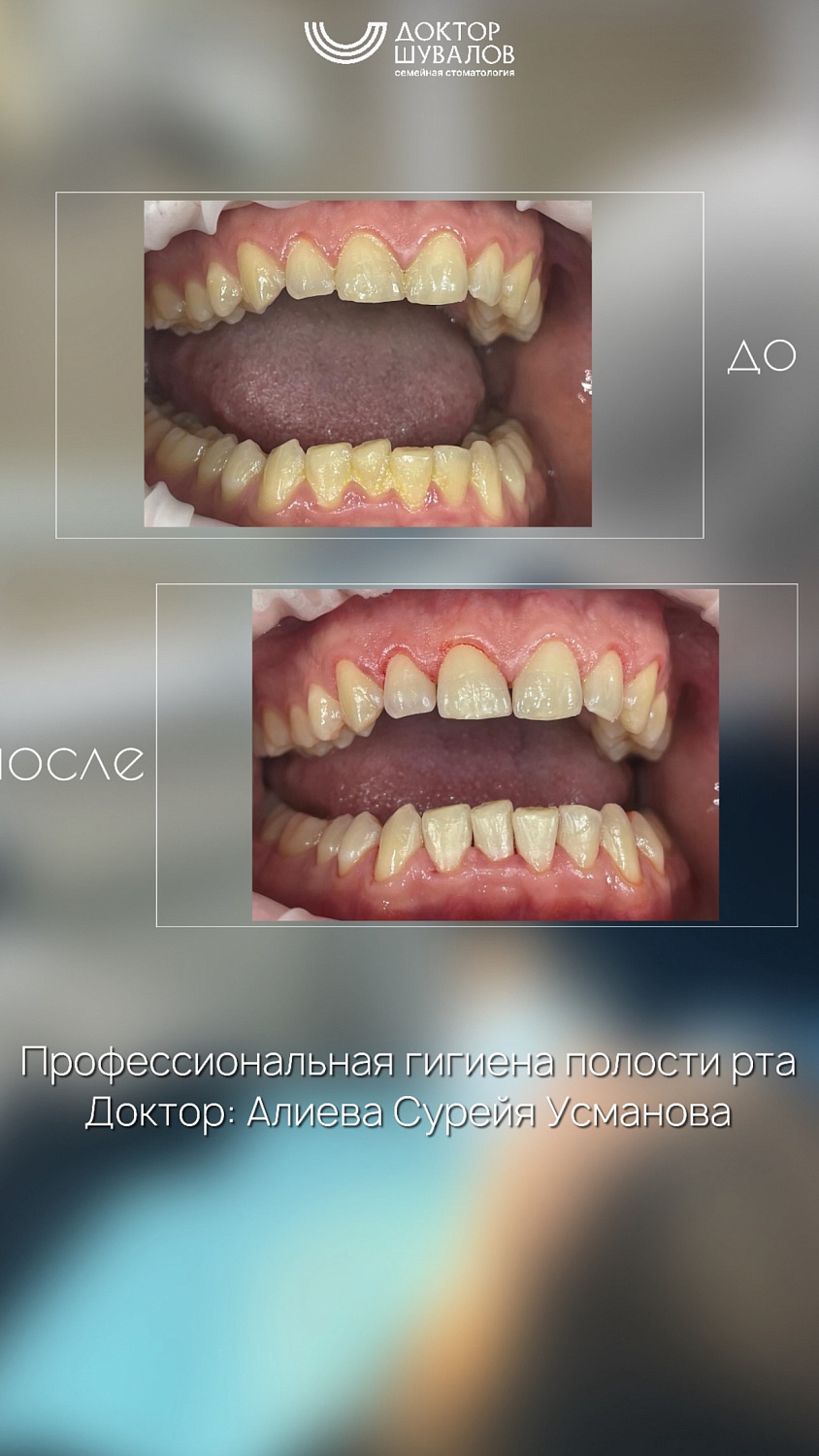 Профессиональная чистка полости рта ультразвуком