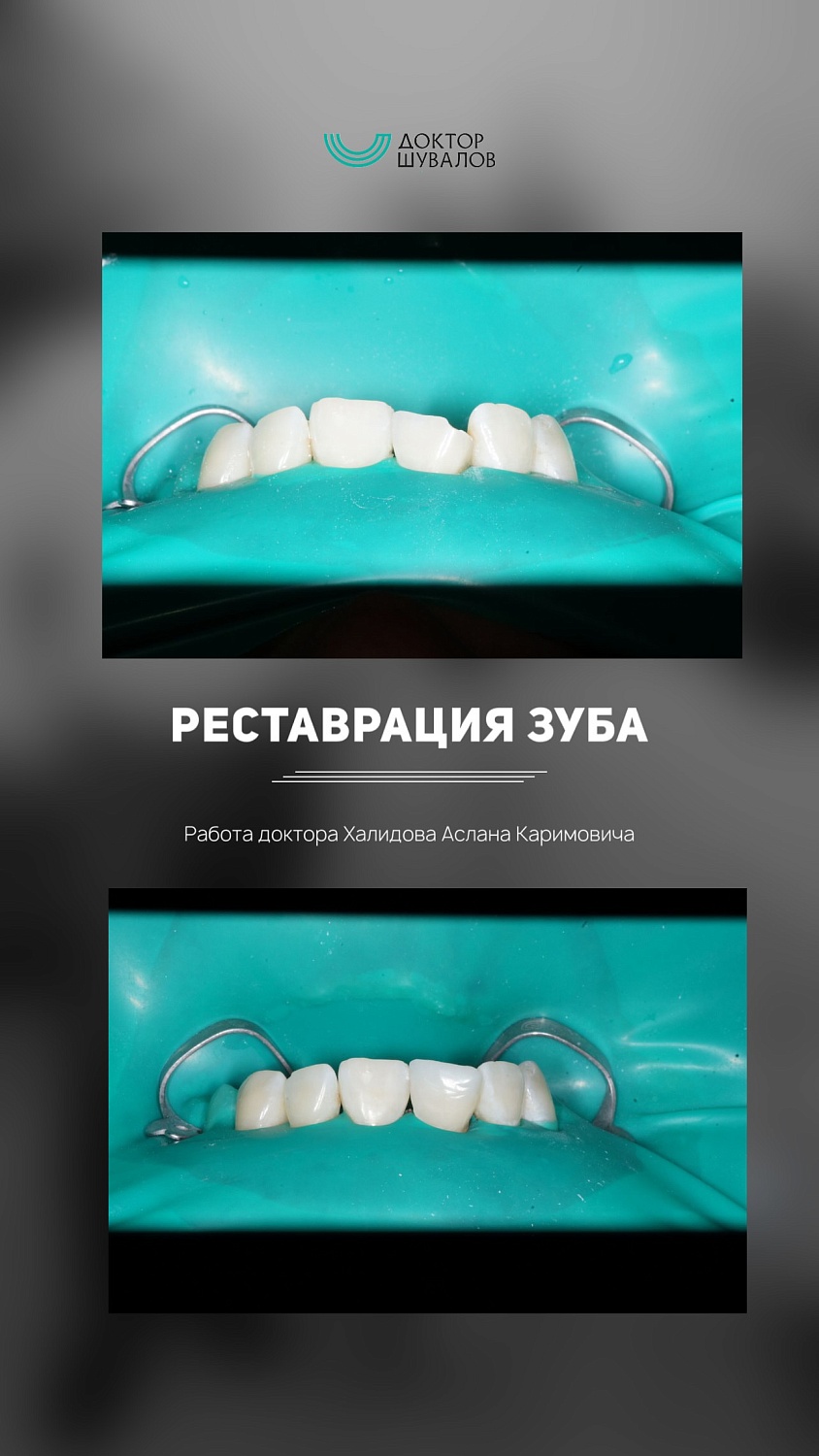 Реставрация зубов