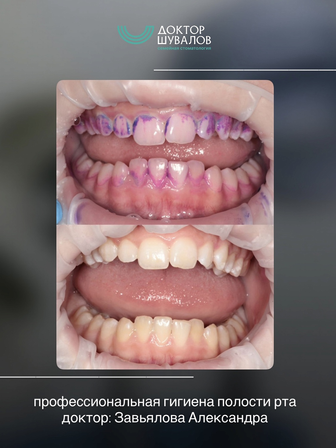 Профессиональная гигиена полости рта flash