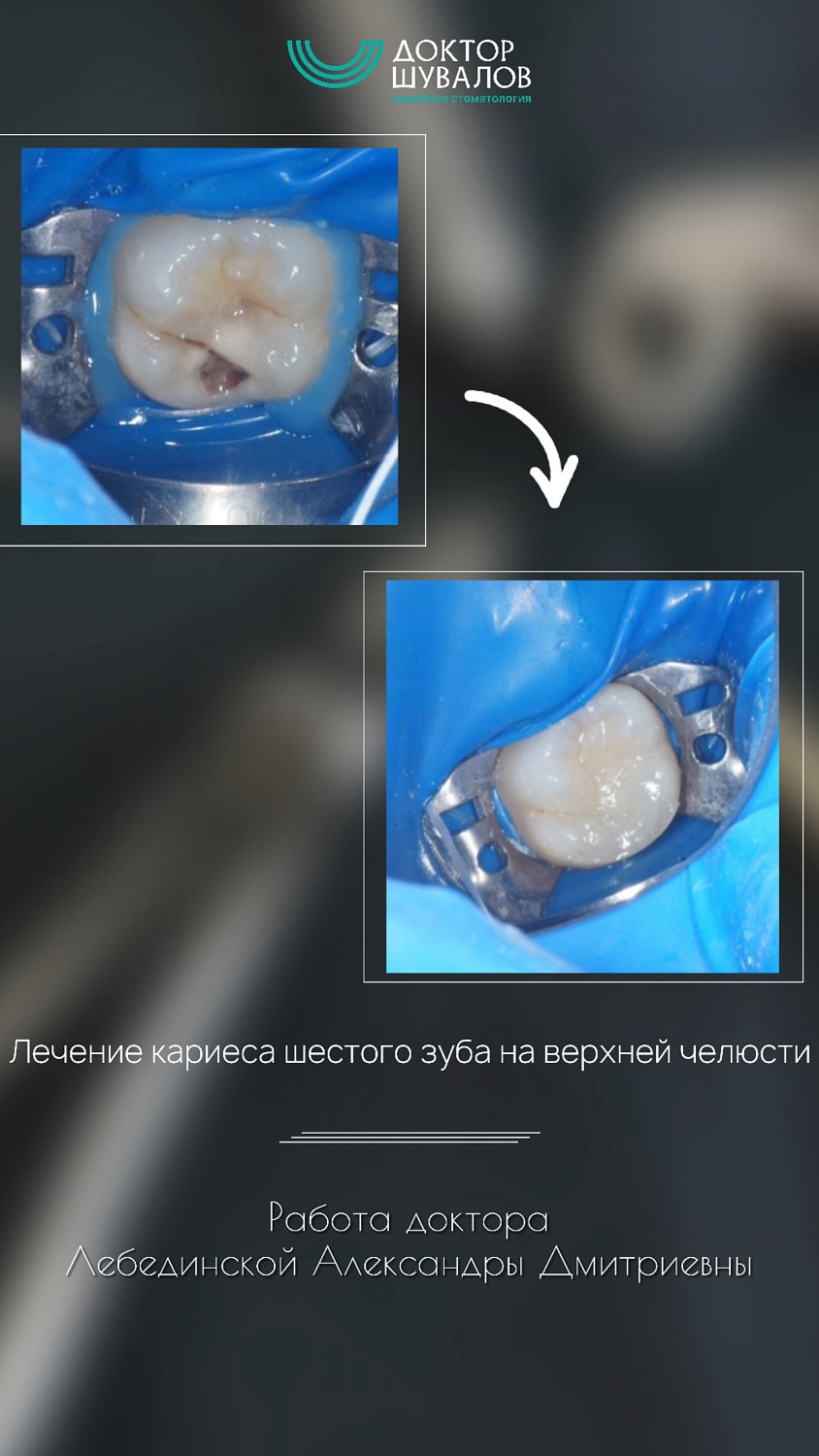 Лечение кариеса