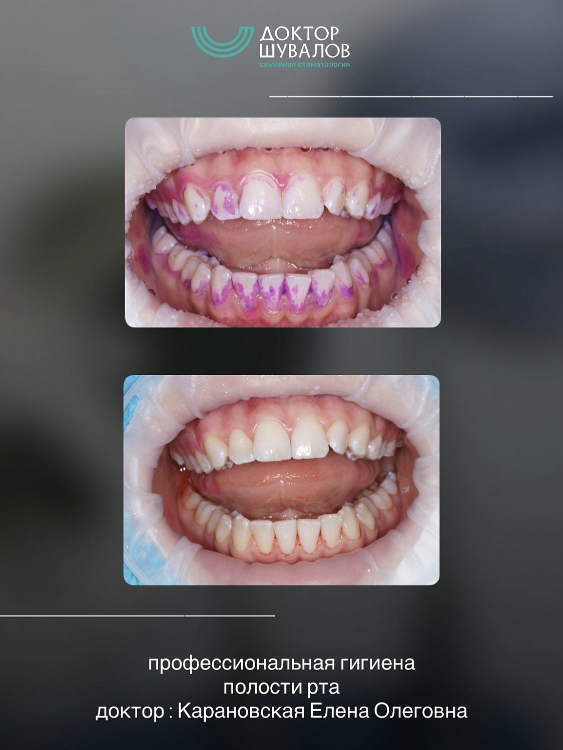 Профессиональная чистка полости рта ультразвуком